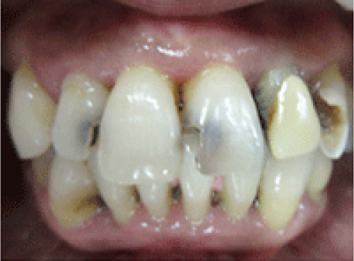 歯周病 症例写真