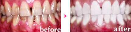 歯の表面についた汚れが原因の場合