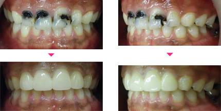 虫歯で歯が黒ずんでいる場合