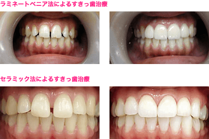 ラミネートべニア法によるすきっ歯治療
