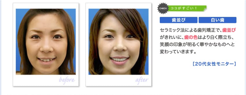 メタルボンド法による歯列矯正で、歯並びがきれいに、歯の色はより白く際立ち、笑顔の印象が明るく華やかなものへと変わっています。