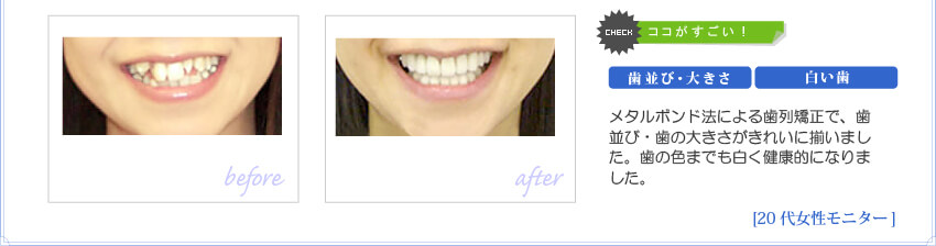 メタルボンド法による歯列矯正で、歯並び・歯の大きさがきれいに揃いました。歯の色までも白く健康的になりました。