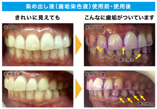 初期虫歯は治療したほうがよいのか ザ ホワイトデンタルクリニック