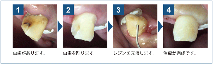 レジンとは?