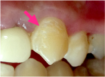 虫歯の写真 画像で見る進行度 ザ ホワイトデンタルクリニック