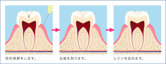 進行度別 奥歯の虫歯法 ザ ホワイトデンタルクリニック