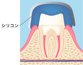 シリコンで歯型をとるイメージ