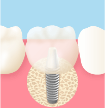 インプラントのイメージ