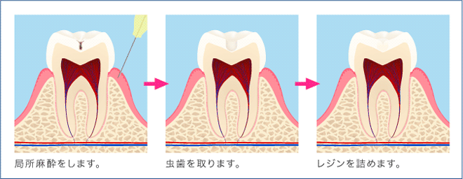 C1治療工程