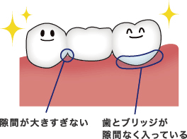 噛み合わせも悪くない様な場合