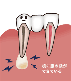 根に膿の袋ができている