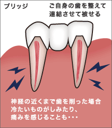 神経の近くまで歯を削った場合冷たいものがしみたり、痛みを感じることも…