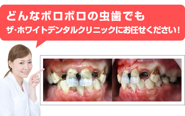 ボロボロの虫歯でも短期間 少回数で治療ok ザ ホワイトデンタルクリニック
