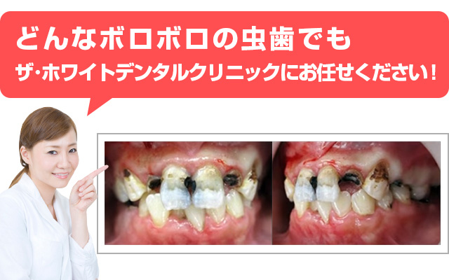 虫歯 産後 産後はなぜ虫歯になりやすい？原因と予防法を知り、ママの歯をケア