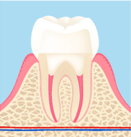クラウン/抜歯