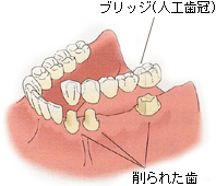 ブリッジ