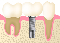 インプラント