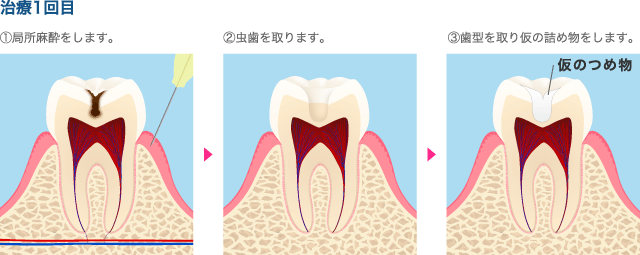 虫歯で穴が開いてしまった場合の治療方法について ザ ホワイトデンタルクリニック