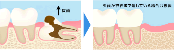 虫歯が神経まで達している場合は抜歯