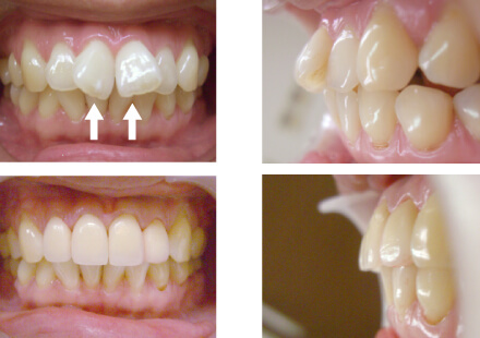 前歯の歯並びが悪い方の矯正方法 ザ ホワイトデンタルクリニック
