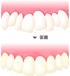 1.歯を削ります