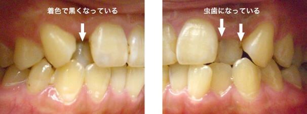 悪い 歯並び 前歯の歯並びが悪いことで起こる６つのこと／きれいに治す治療法