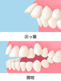 出っ歯　開咬　の図