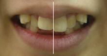 歯の大きさ、向き、形が左右対称である