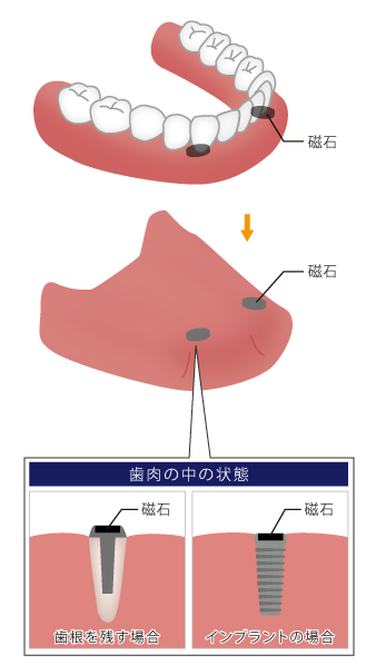 マグネットデンチャー