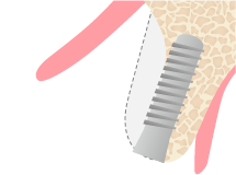  インプラントを歯槽骨へ埋入します