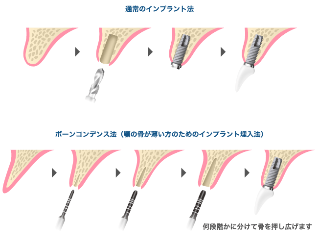 通常のインプラント法　ボーンコンデンス法