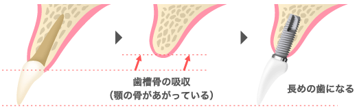 歯槽骨の吸収