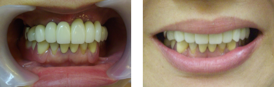 前歯の治療症例写真