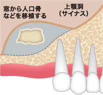 サイナスリフト ステップ02