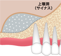 サイナスリフト ステップ03