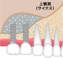 サイナスリフト ステップ04