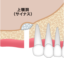 ソケットリフト ステップ01