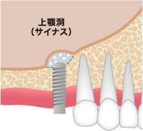 ソケットリフト ステップ02