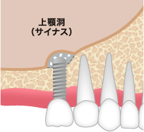 ソケットリフト ステップ03