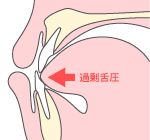 舌の悪習癖