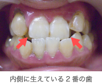 内側に生えている2番の奥