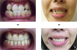 受け口と歯並び治療例