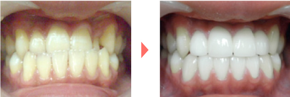 セラミック法 症例写真