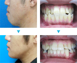 受け口 反対咬合 は矯正で治りますか ザ ホワイトデンタルクリニック