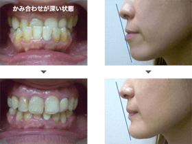 受け口 反対咬合 はどのような横顔になりますか ザ ホワイトデンタルクリニック