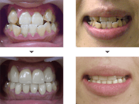 受け口治療の症例