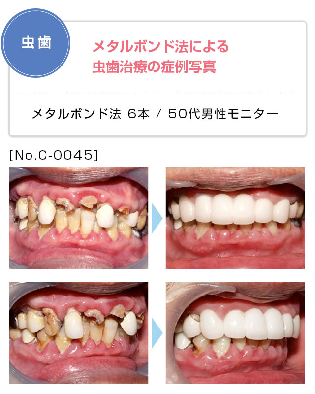 矯正 ピュア ライン 新 マウスピース矯正システム「シュアスマイル・アライナー」パッケージのご紹介です