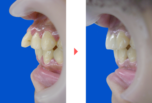 前歯の出っ歯の治療法 ザ ホワイトデンタルクリニック