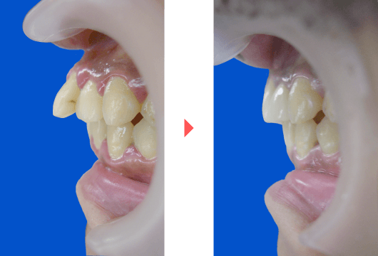前歯の出っ歯の治療法 ザ ホワイトデンタルクリニック
