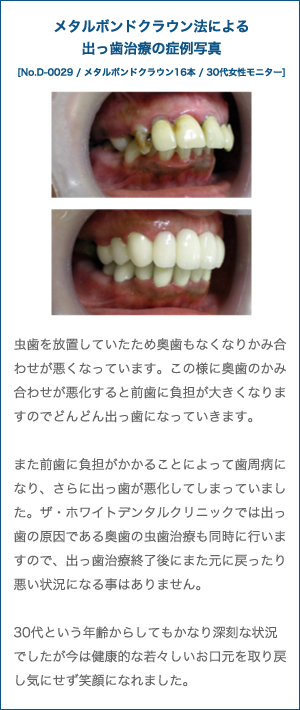 差し歯 できない 前歯 前歯の差し歯は保険で治るよ！自費診療と違うのはココ